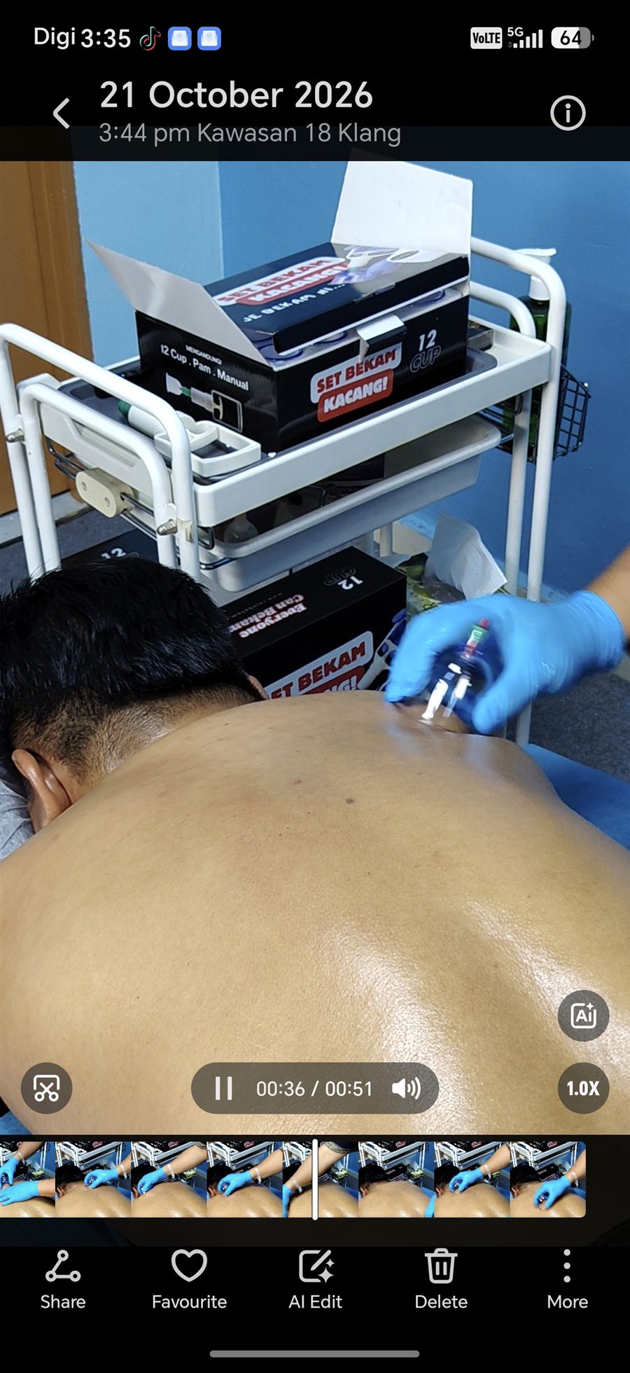 Perawat meletakkan cawan bekam pada belakang pelanggan